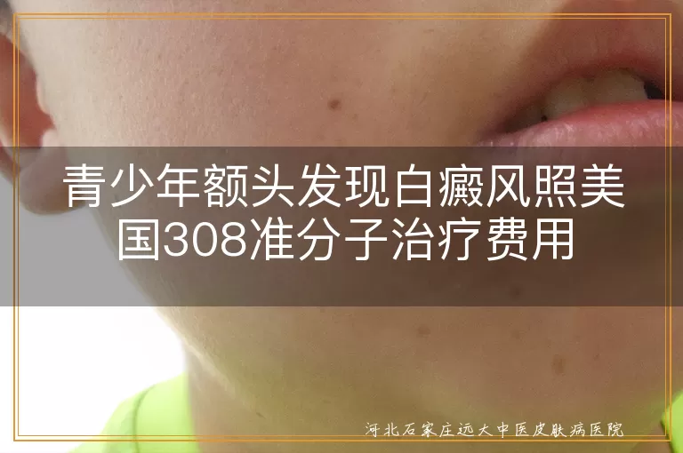 青少年额头白癜风308准分子治疗白斑费用,青少年白癜风白斑美国308治疗花费,308准分子治疗青少年白斑价格