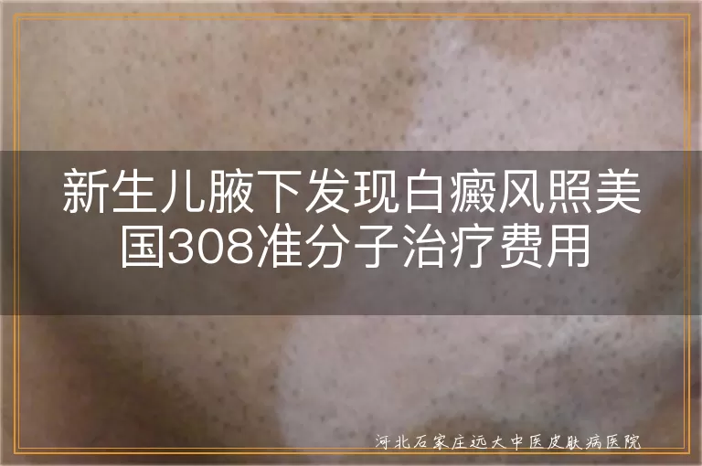 新生儿腋下白斑照308激光费用,婴儿白癜风美国308治疗价格,腋下白斑美国308准分子花费