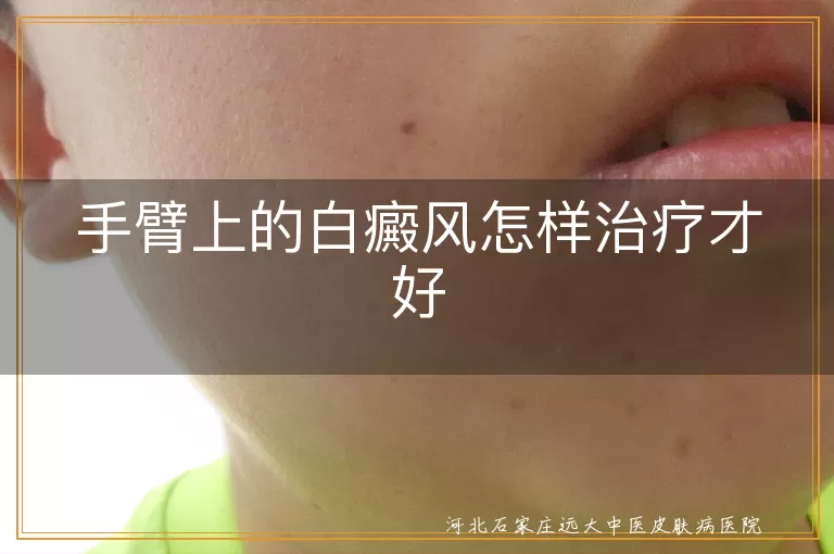 手臂上的白癜风怎样治疗才好