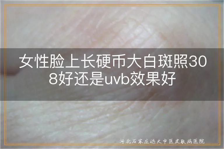 女性脸上长硬币大白斑照308好还是uvb效果好