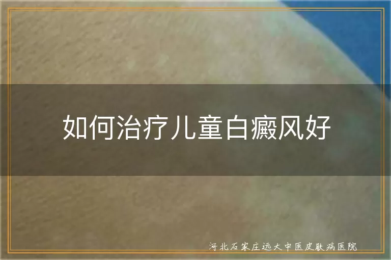 如何治疗儿童白癜风好