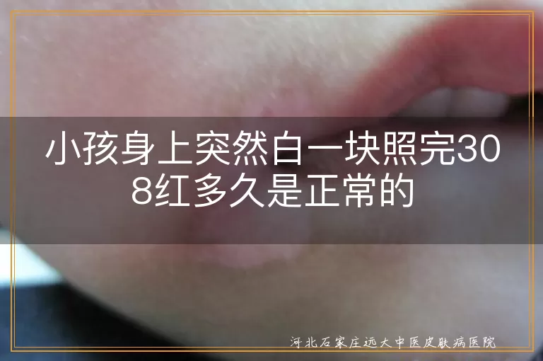 白斑照308后红肿多久算正常,孩子白癜风照光后红几天,儿童白斑308激光后红印持续时间