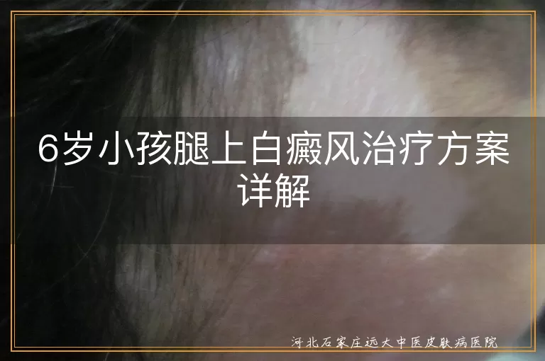 6岁娃腿部白斑如何治,小儿腿上白癜风疗法,儿童腿部白斑康复方案