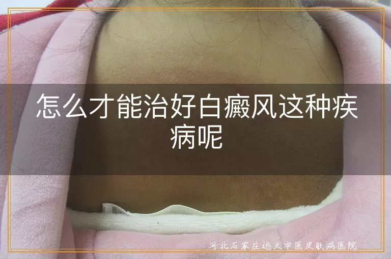 怎么才能治好白癜风这种疾病呢