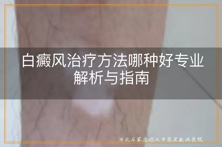 白癜风治疗方法哪种好专业解析与指南