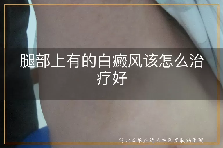 腿部白斑怎么治,白癜风腿部治疗方案,腿部白癜风治疗建议