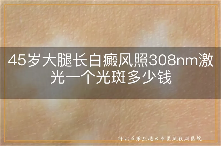 大腿白癜风308激光费用,白斑激光价格,白癜风光斑收费