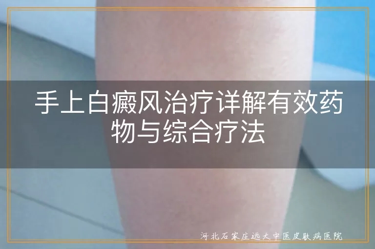 手上白癜风治疗详解有效药物与综合疗法
