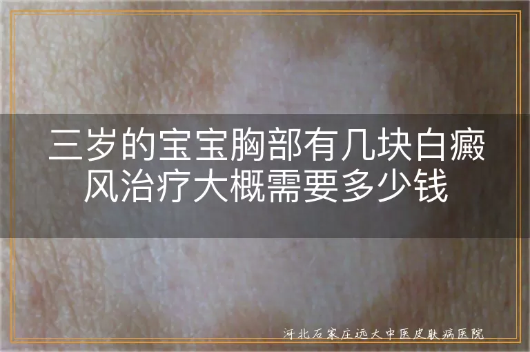三岁宝宝胸部白斑怎么治,三岁白癜风治疗要花多久,三岁白斑治疗过程注意事项