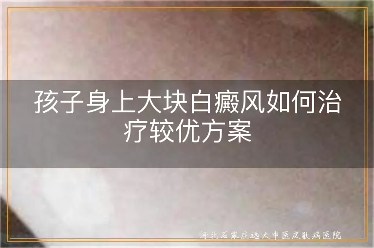 儿童大面积白斑治疗,小儿白癜风安全疗法,儿童白斑复色攻略