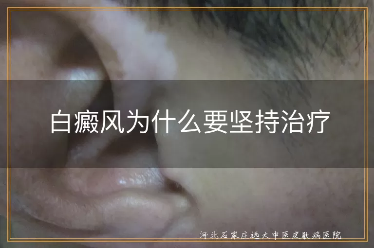 白癜风为什么要坚持治疗
