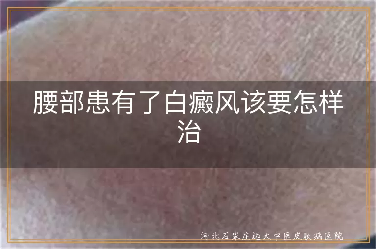 腰部患有了白癜风该要怎样治