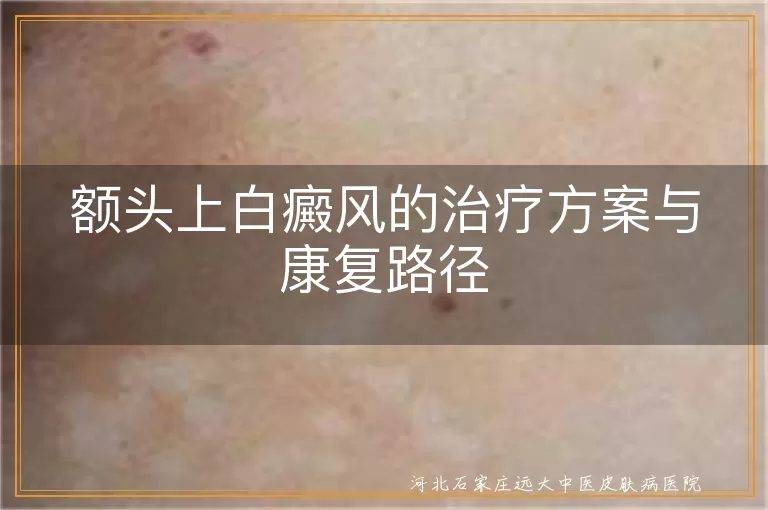 额头白斑光疗康复路径,白癜风中医调理额头,额头白癜风饮食与心理