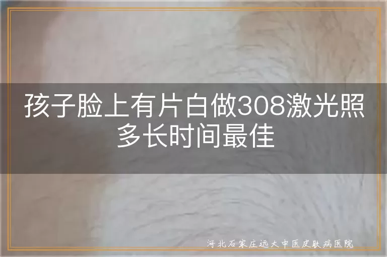 孩子脸上有片白做308激光照多长时间最佳