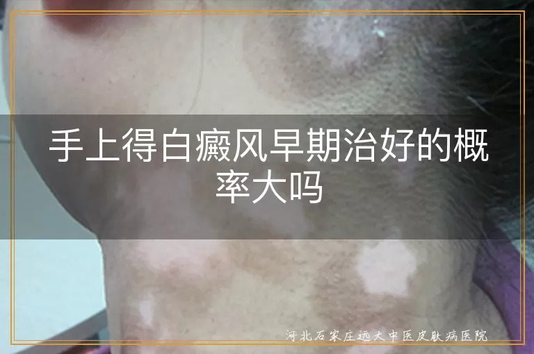 手部白癜风早期治愈率,手指白斑治疗时机,白癜风初期康复概率