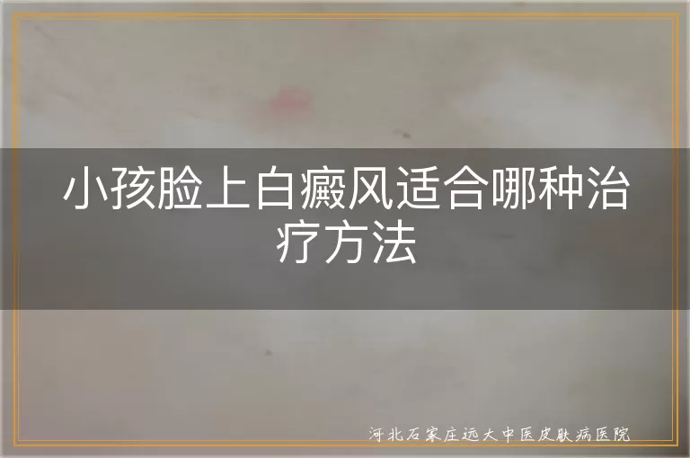 儿童面部白癜风治疗方法,小孩脸上白斑怎么治,婴幼儿白癜风治疗方式