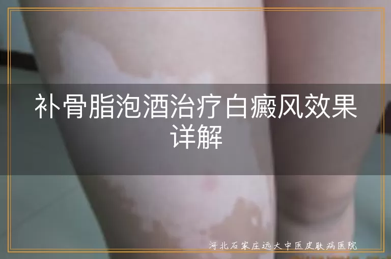 补骨脂泡酒治白癜风效果如何,白癜风中药泡酒疗法详解,白斑患者能用补骨脂泡酒吗