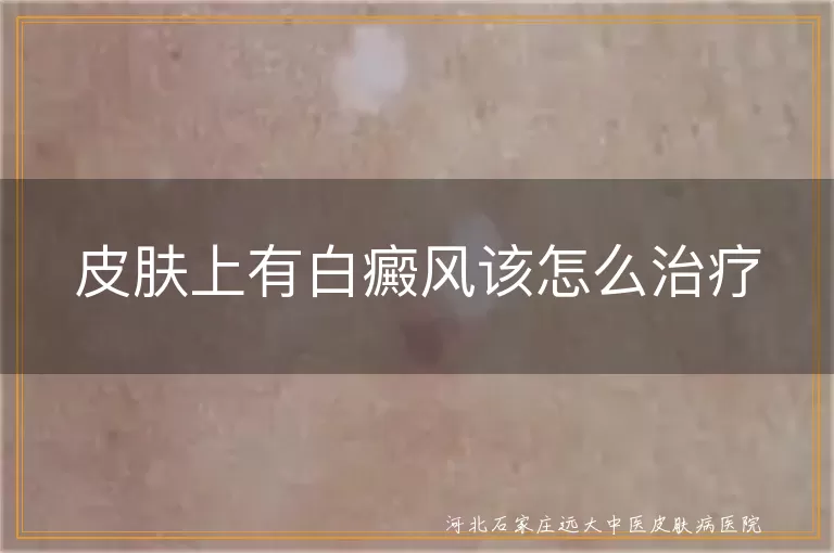 皮肤上出现白癜风怎么治疗,白斑疾病的科学治疗方法,白癜风患者的正确治疗方式