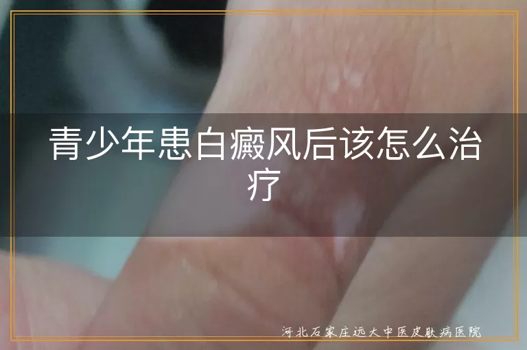 青少年患白癜风后该怎么治疗