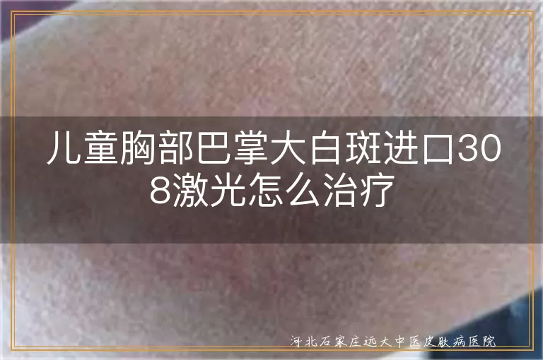 儿童胸部白癜风进口308激光治疗,儿童大面积白斑308激光治疗方案,儿童巴掌大白癜风照光注意事项