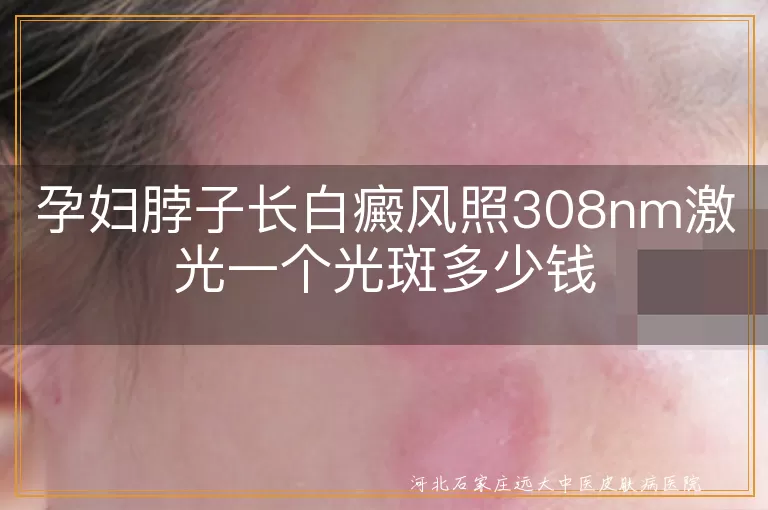 孕妇白癜风治疗费用,脖子白斑308激光价格,孕期白癜风光疗多少钱