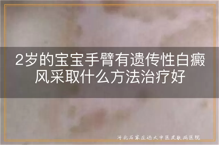 2岁宝宝手臂白癜风怎么治疗好,遗传性白癜风婴幼儿治疗方法,幼儿手臂白斑安全治疗方式