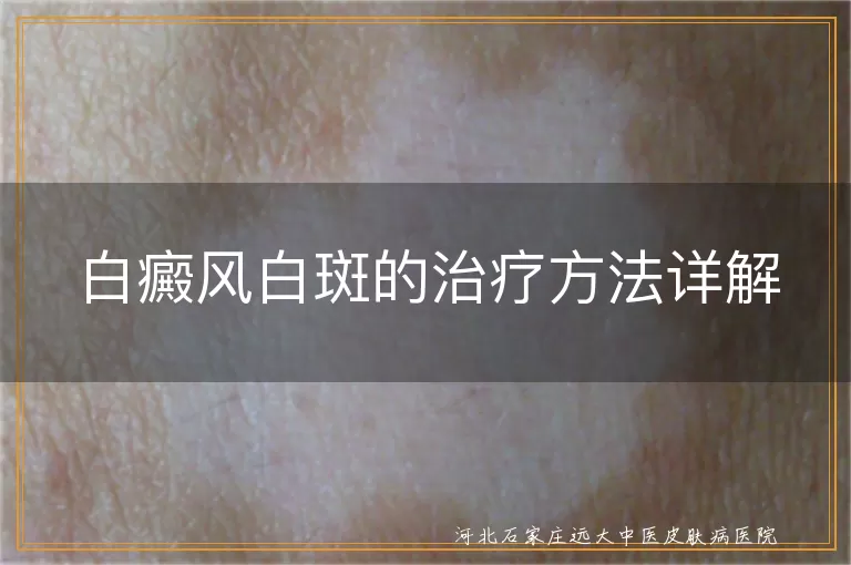 白癜风白斑的治疗方法详解