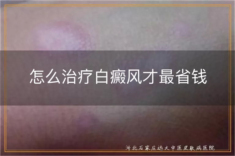 白癜风治疗费用怎么节省,白斑患者如何降低开支,治疗白癜风省钱又有效的方法