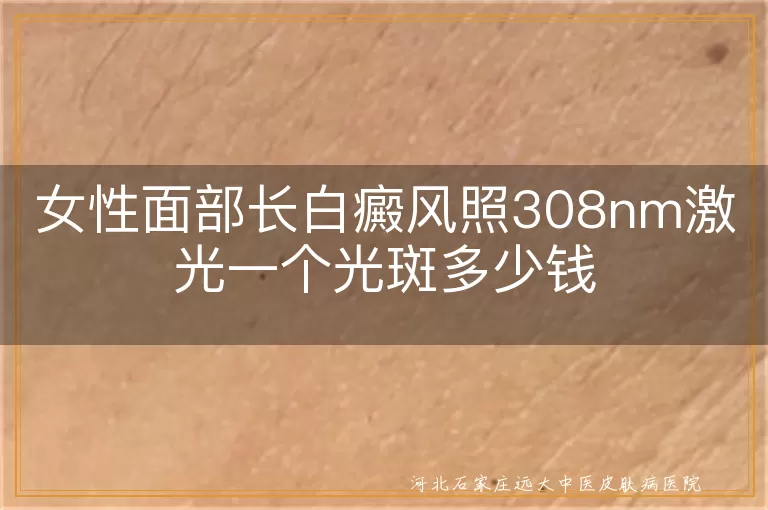 女性面部长白癜风照308nm激光一个光斑多少钱