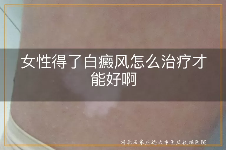 女性白癜风患者如何科学治疗,女性白斑病情怎么有效控制,女性白癜风治疗注意事项有哪些