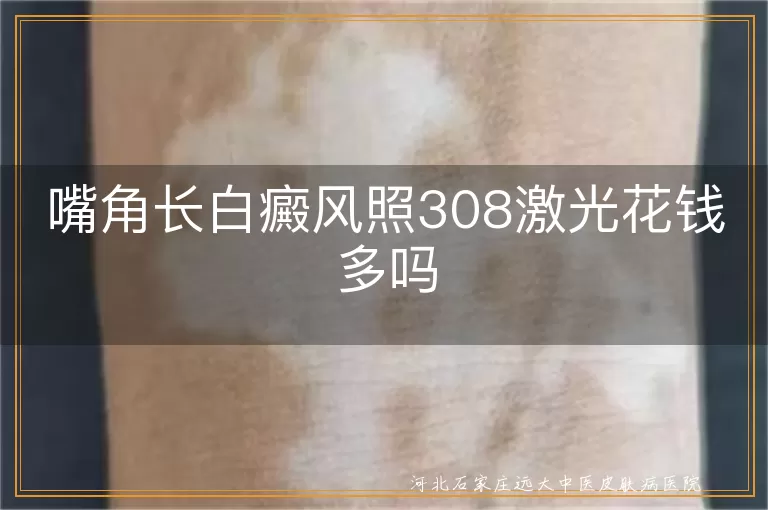 嘴角长白癜风照308激光花钱多吗