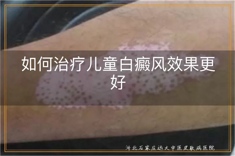 如何治疗儿童白癜风效果更好