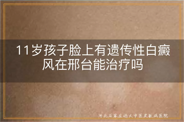 11岁孩子脸上有遗传性白癜风在邢台能治疗吗