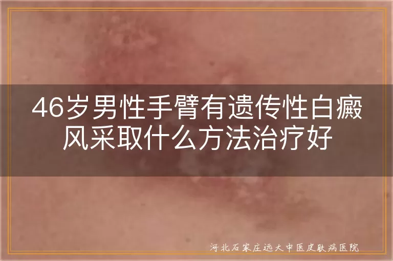 46岁男性手臂有遗传性白癜风采取什么方法治疗好