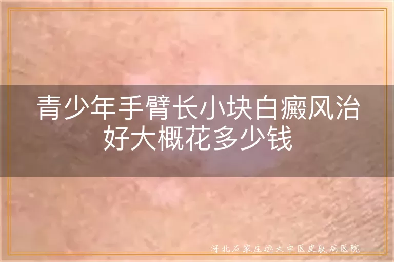 青少年手臂长小块白癜风治好大概花多少钱