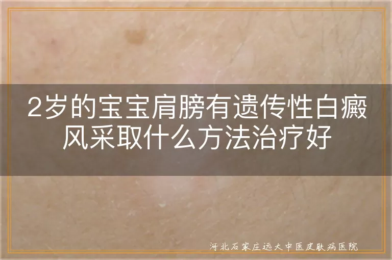 2岁的宝宝肩膀有遗传性白癜风采取什么方法治疗好