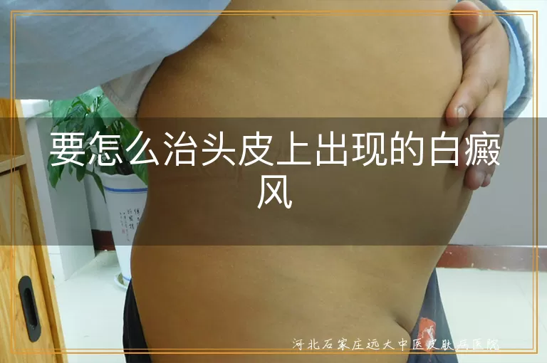 头皮白癜风治疗方法,头部白斑护理要点,白癜风头皮部位治疗