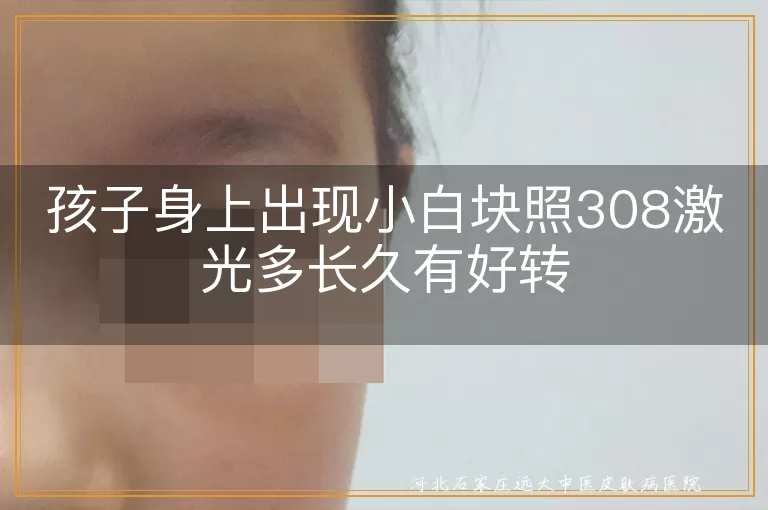 儿童白癜风照308激光多久见效,白斑患儿308治疗效果,白癜风308激光好转时间