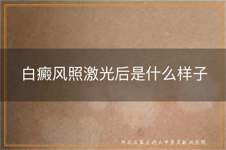 白癜风照激光后是什么样子