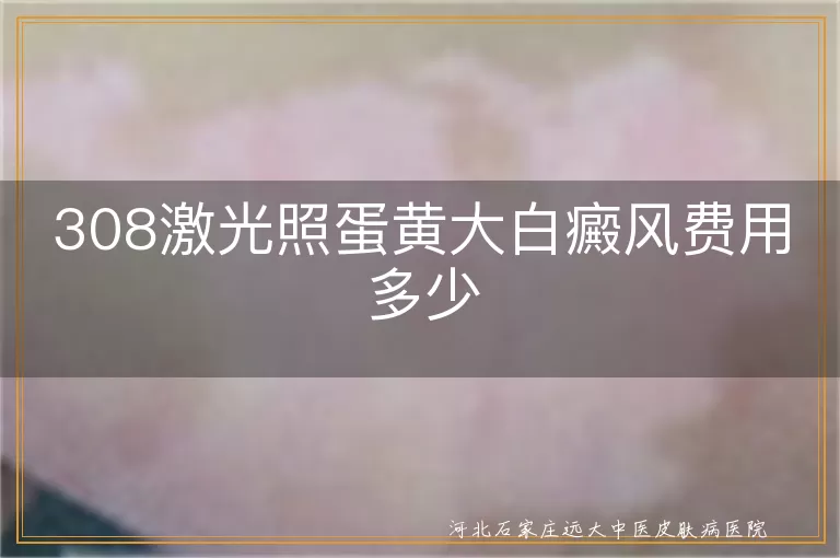 308激光照蛋黄大白癜风费用多少