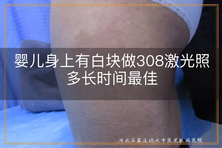 婴儿身上有白块做308激光照多长时间最佳