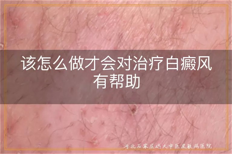 该怎么做才会对治疗白癜风有帮助