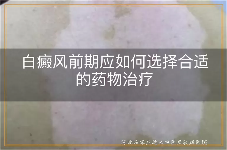 白癜风前期药物怎么选,白斑初期治疗用药指南,白癜风患者早期用药建议