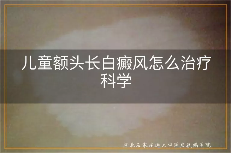 儿童额头白癜风怎么治,小孩额头白斑科学疗法,儿童面部白癜风治疗