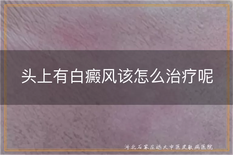 头皮白癜风治疗方法,头部白斑怎么治,头上白癜风能治好吗