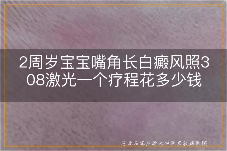 幼儿嘴角白癜风治疗费用,2岁宝宝白斑308激光价格,儿童白癜风308光疗疗程费用