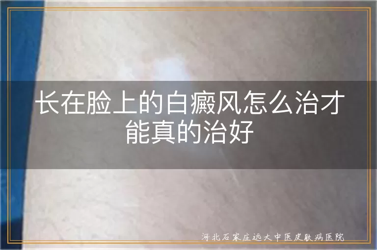 `面部白癜风到底应该怎么治才能康复,脸上出现白斑科学治疗方法有哪些,脸部白癜风要怎么做才能真正治好`