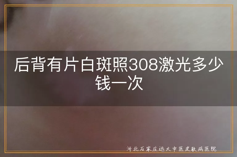后背出现白癜风照308激光费用多少,后背长白斑照308价格是多少,背部白斑照308激光治疗一次多少钱