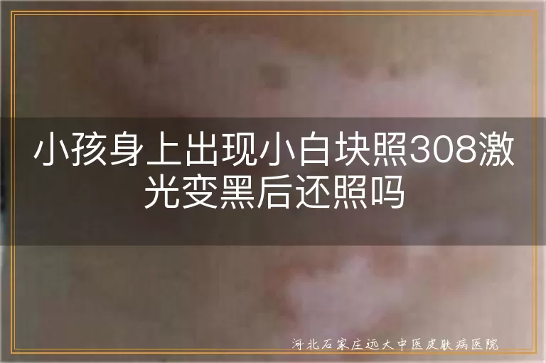 小孩身上出现小白块照308激光变黑后还照吗