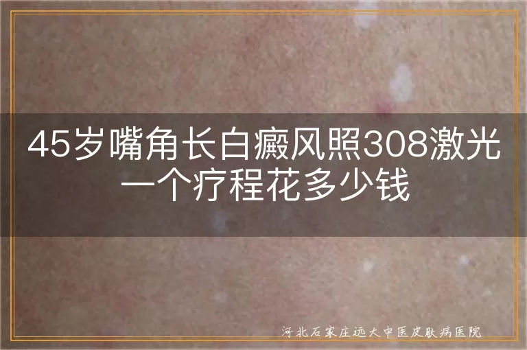 45岁嘴角长白癜风照308激光一个疗程花多少钱